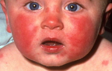 Steroid cream eczema infants